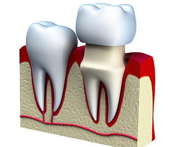 Affordable crowns for teeth from dentist in Dothan, AL