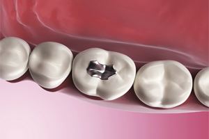 Silver Mercury Fillings Dothan - Image for Silver Mercury Fillings