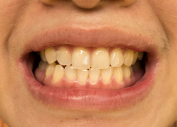 Laser Gum Surgery Dothan - Healthy Laser Gums Treatment