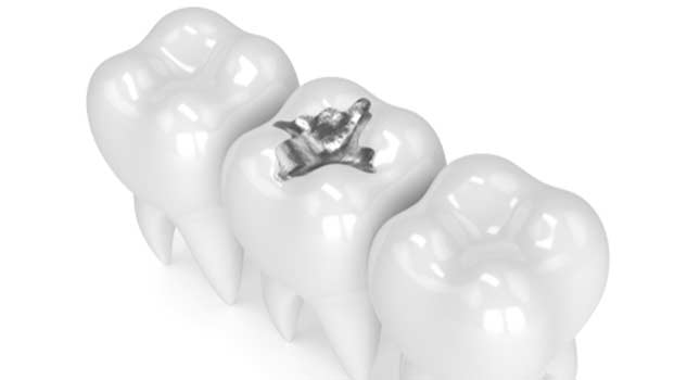 3d render of teeth with dental amalgam filling over white background