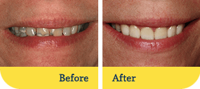 Dothan Cosmetic Dentist Before After Teeth