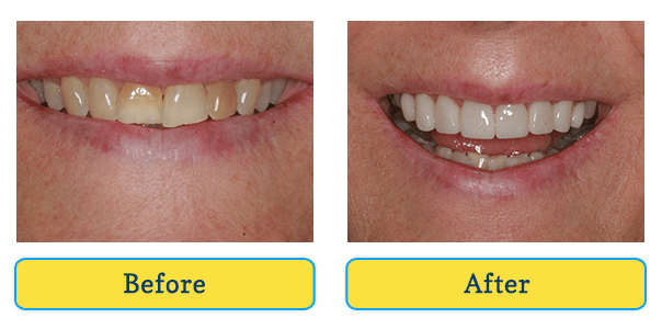 Before and After teeth 2