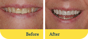 Smile Makeover Dothan Before After Teeth
