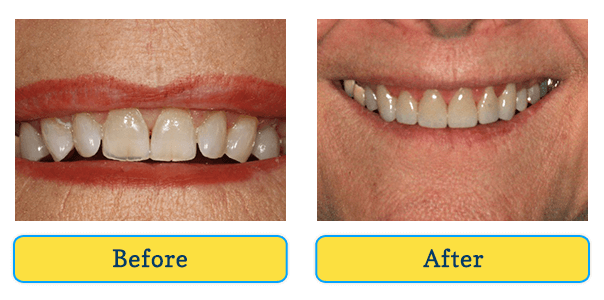 Before and After teeth 4