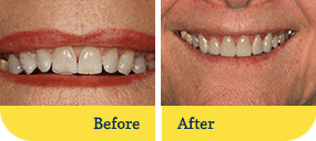 Teeth Whitening Before After Dothan