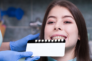 Dental Veneers Dothan - Shade Determination